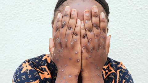 eine mit dem Mpox-Virus infizierte Frau in einem Spital in Bujumbura, Burundi