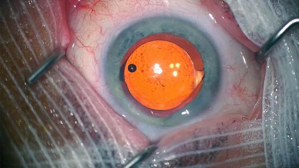 ein freigelegtes Auge während einer Operation