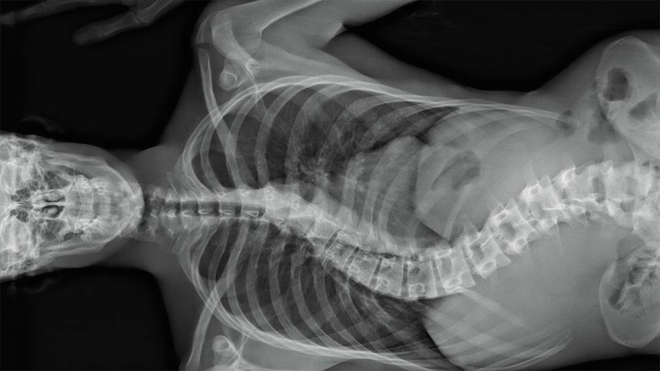 Röntgenbild einer Wirbelsäule mit Skoliose